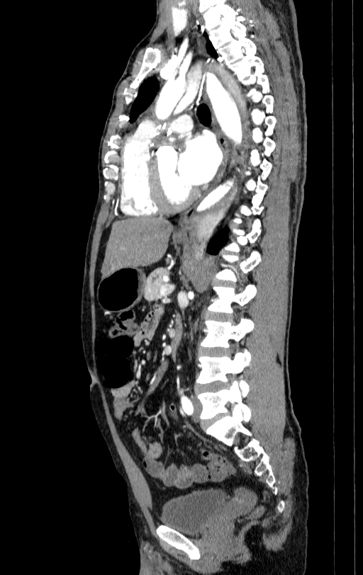 Aortic dissection - Stanford type A (Radiopaedia 83418-98500 B 43).jpg