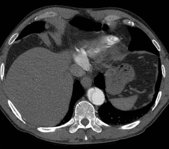 File:Aortic dissection - Stanford type B (Radiopaedia 73648-84437 A 94).jpg