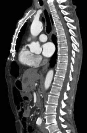 File:Aortic dissection - Stanford type B (Radiopaedia 73648-84437 C 79).jpg