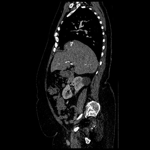 File:Aortic dissection - Stanford type B (Radiopaedia 88281-104910 C 25).jpg
