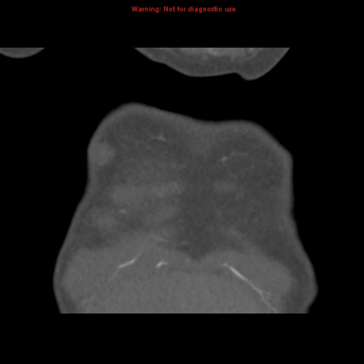 File:Aortic ductus diverticulum (Radiopaedia 8339-9180 B 6).jpg