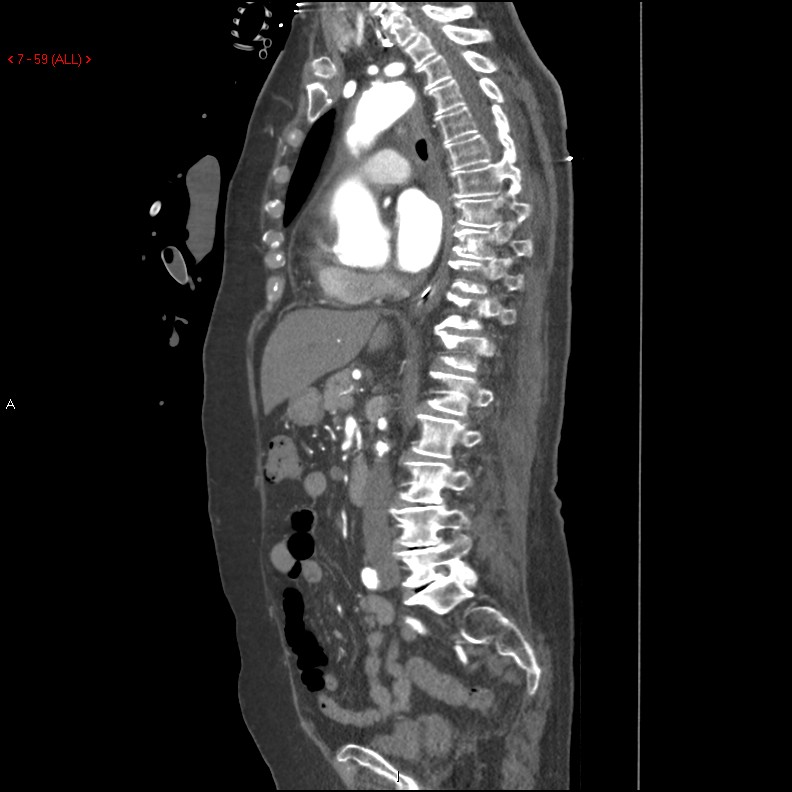 Aortic intramural hematoma (Radiopaedia 27746-28001 C 28).jpg