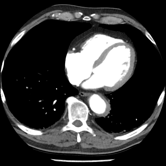 Aortic intramural hematoma (type B) (Radiopaedia 79323-92387 B 38).jpg