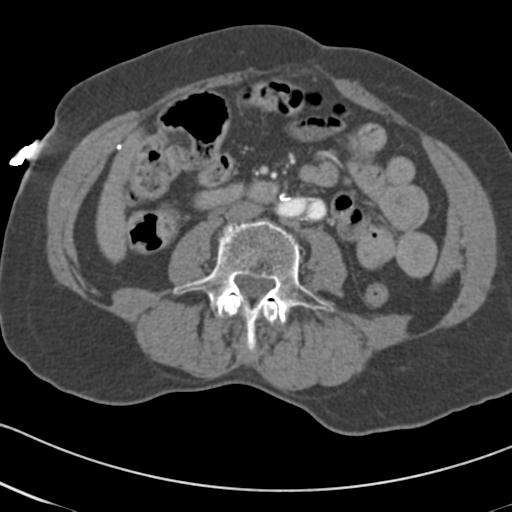 Aortic intramural hematoma from penetrating atherosclerotic ulcer (Radiopaedia 31137-31836 A 118).jpg