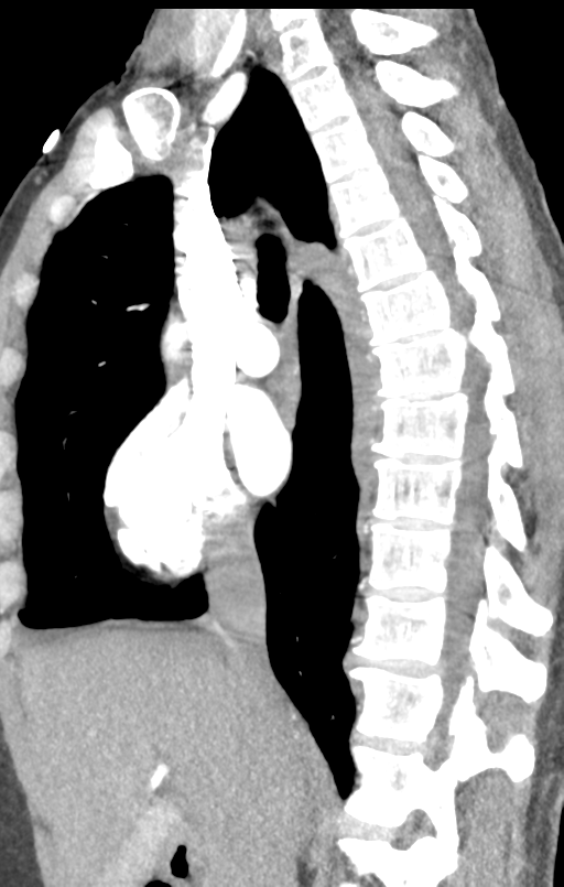 Aortic valve non-coronary cusp thrombus (Radiopaedia 55661-62189 C+ arterial phase 36).png