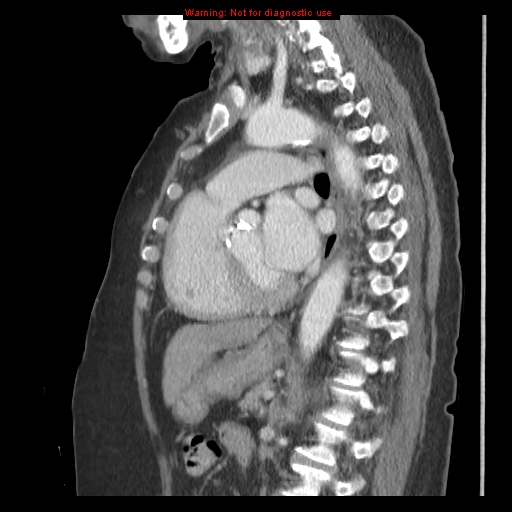 File:Aortic valve stenosis (Radiopaedia 14480-14423 B 6).jpg
