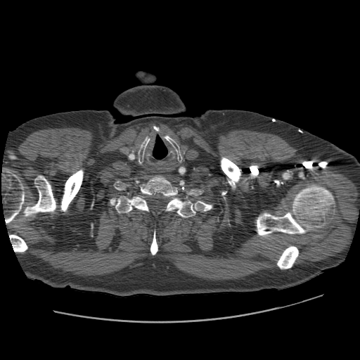 File:Aorto-coronary bypass graft aneurysms (Radiopaedia 40562-43157 A 10).png