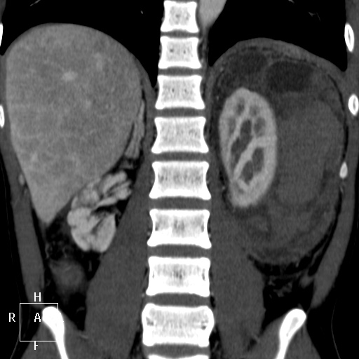 File:Aorto-left renal vein fistula (Radiopaedia 45534-49628 B 48).jpg
