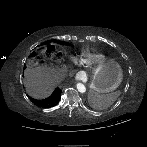 Aortoesophageal fistula with endovascular repair (Radiopaedia 73781-84592 Axial C+ CTPA 137).jpg