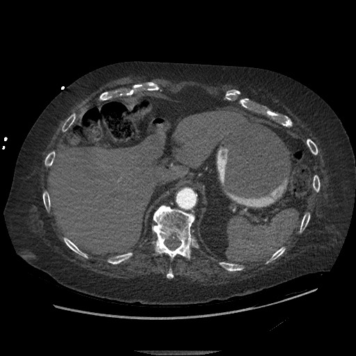 Aortoesophageal fistula with endovascular repair (Radiopaedia 73781-84592 Axial C+ CTPA 165).jpg