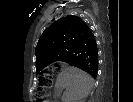 File:Aortoesophageal fistula with endovascular repair (Radiopaedia 73781-84592 Sagittal C+ CTPA 51).jpg