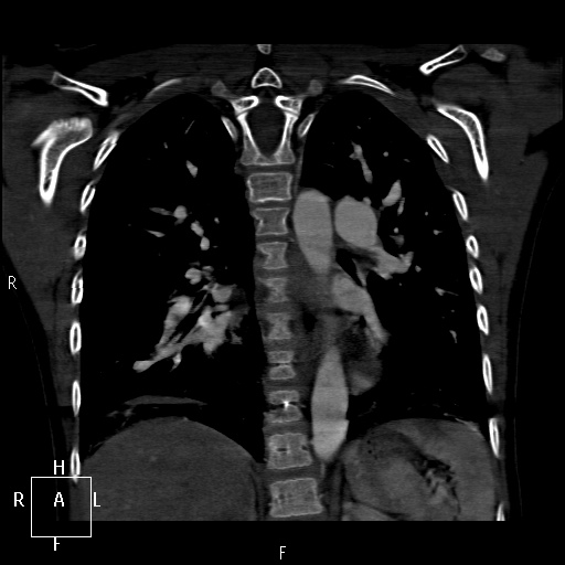 File:Aortopulmonary septal defect (Radiopaedia 41990-45013 Coronal C+ CTPA 46).jpg