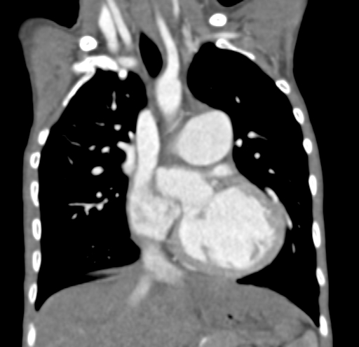 File:Aortopulmonary window, interrupted aortic arch and large PDA giving the descending aorta (Radiopaedia 35573-37074 D 30).jpg
