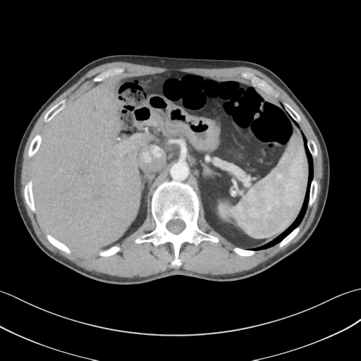File:Apical pleural calcification (Radiopaedia 46141-50499 Axial C+ delayed 71).png