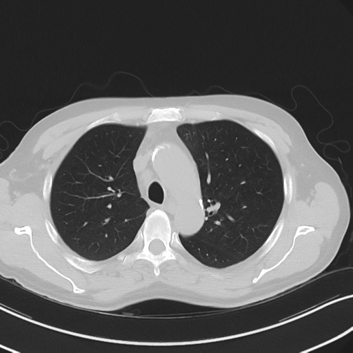 Apical pulmonary metastasis (Radiopaedia 46338-50754 Axial non-contrast 21).png