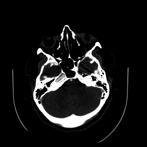 Aplasia of the internal carotid artery (Radiopaedia 61082-68960 A 18).jpg