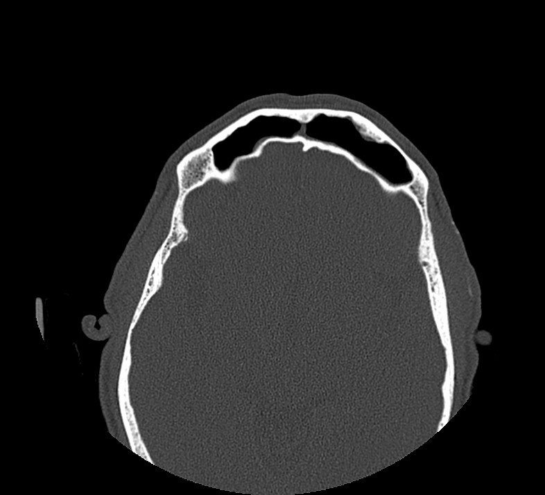Aplastic maxillary sinuses (Radiopaedia 60030-67561 Axial non-contrast 62).jpg