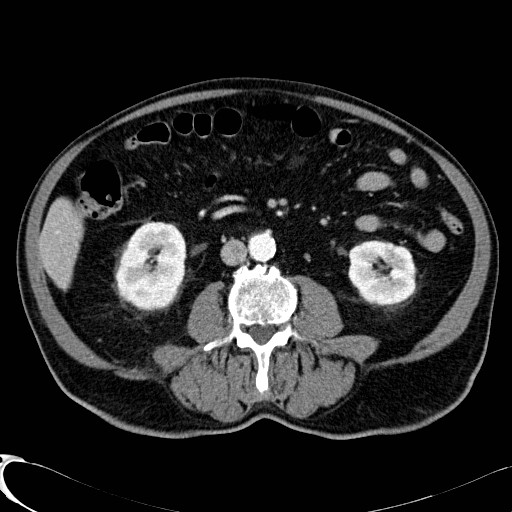 File:Appendiceal adenocarcinoma complicated by retroperitoneal abscess (Radiopaedia 58007-65039 B 70).jpg