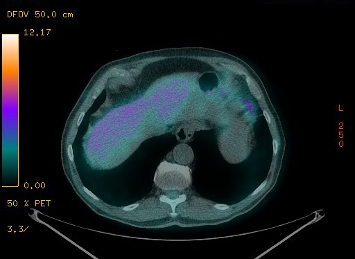 Appendiceal adenocarcinoma complicated by retroperitoneal abscess (Radiopaedia 58007-65041 Axial PET-CT 100).jpg