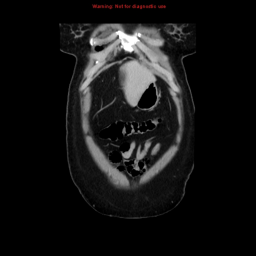 Appendiceal mucinous cystadenoma (Radiopaedia 8263-9111 B 10).jpg