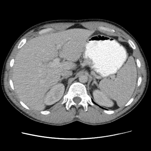 File:Appendicitis complicated by post-operative collection (Radiopaedia 35595-37114 A 22).jpg
