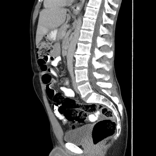 Appendicitis complicated by post-operative collection (Radiopaedia 35595-37114 C 39).jpg