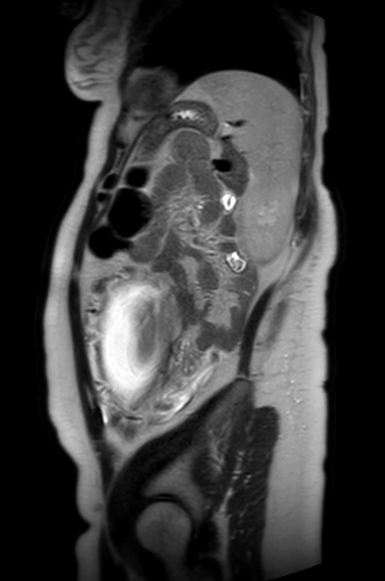 Appendicitis in gravida (MRI) (Radiopaedia 89433-106395 Sagittal T2 17).jpg