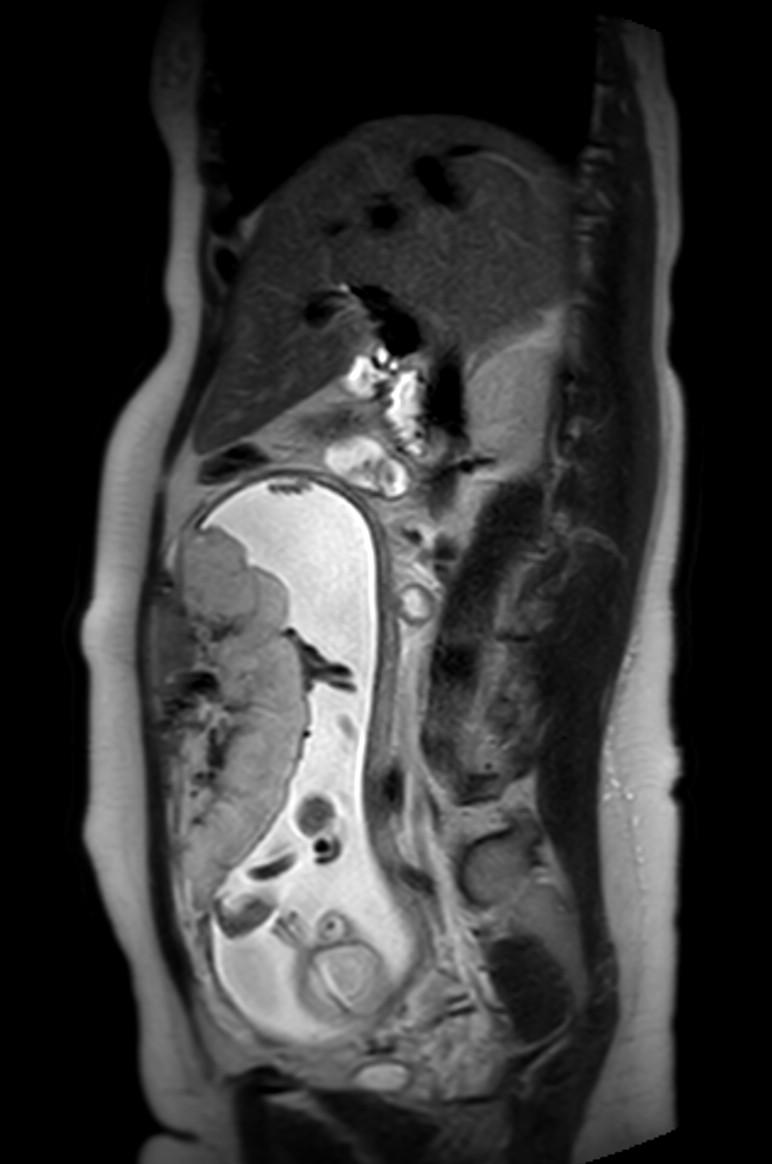 Appendicitis in gravida (MRI) (Radiopaedia 89433-106395 Sagittal T2 39).jpg
