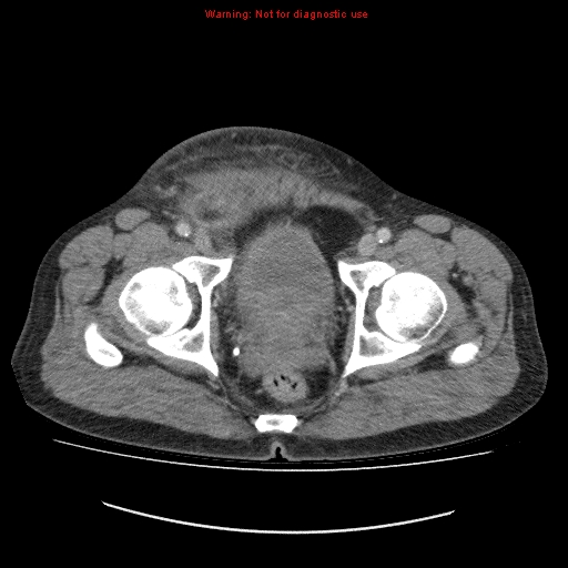 File:Appendicitis mass in inguinal hernia (Radiopaedia 26858-27029 A 26).jpg