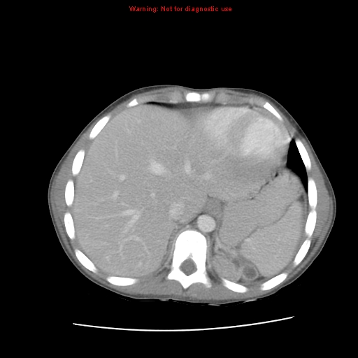 File:Appendicitis with phlegmon (Radiopaedia 9358-10046 A 14).jpg