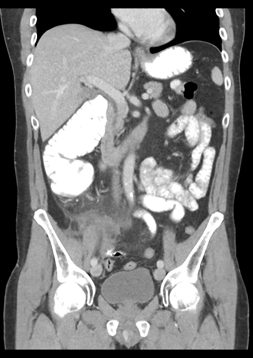 Appendicitis with thickening of the terminal ileum (Radiopaedia 42432-45550 B 28).png