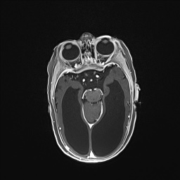 Aqueductal stenosis (Radiopaedia 73974-84802 Axial T1 C+ 68).jpg