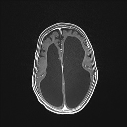 Aqueductal stenosis (Radiopaedia 73974-84802 Axial T1 C+ 97).jpg