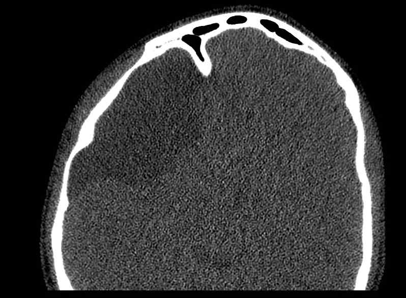 Arachnoid cyst- extremely large (Radiopaedia 68741-78450 Axial bone window 51).jpg