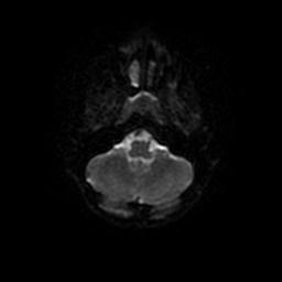 Arachnoid cyst - middle cranial fossa (Radiopaedia 67671-77088 Axial DWI 32).jpg