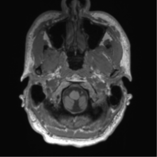 File:Arachnoid cyst with subdural hematoma (Radiopaedia 85892-101743 Axial T1 12).png