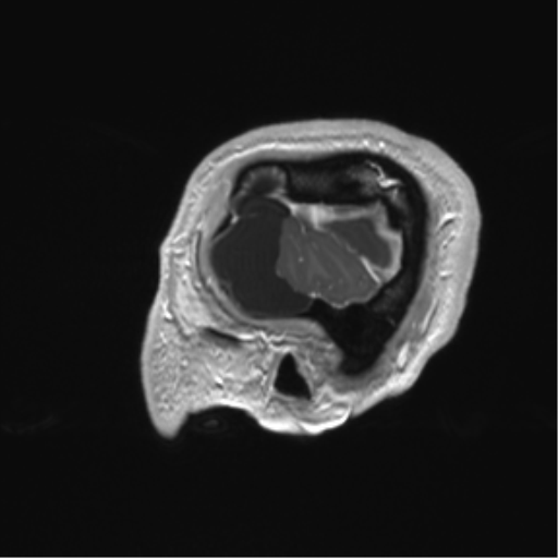 Arachnoid cyst with subdural hematoma (Radiopaedia 85892-101743 Sagittal T1 C+ 11).png