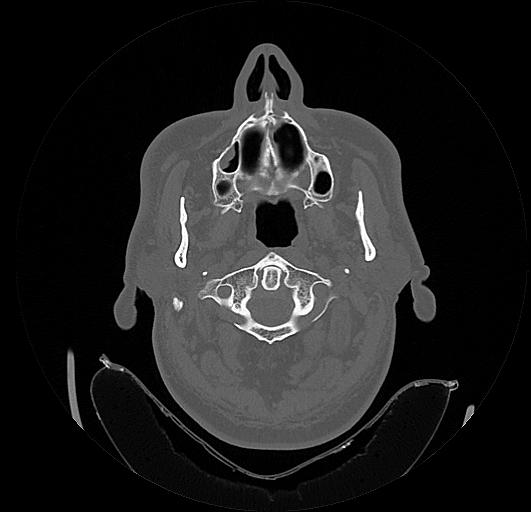 Arcuate foramen (Radiopaedia 89833-106944 Axial bone window 24).jpg