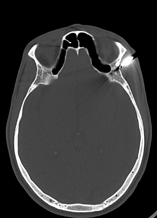 Arrow injury to the head (Radiopaedia 75266-86388 Axial bone window 71).jpg