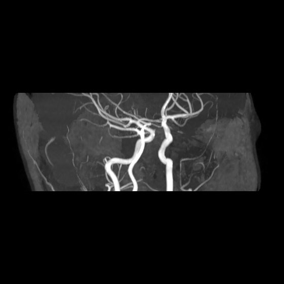 File:Artery of Percheron infarct (Radiopaedia 40966-43676 G 17).jpg