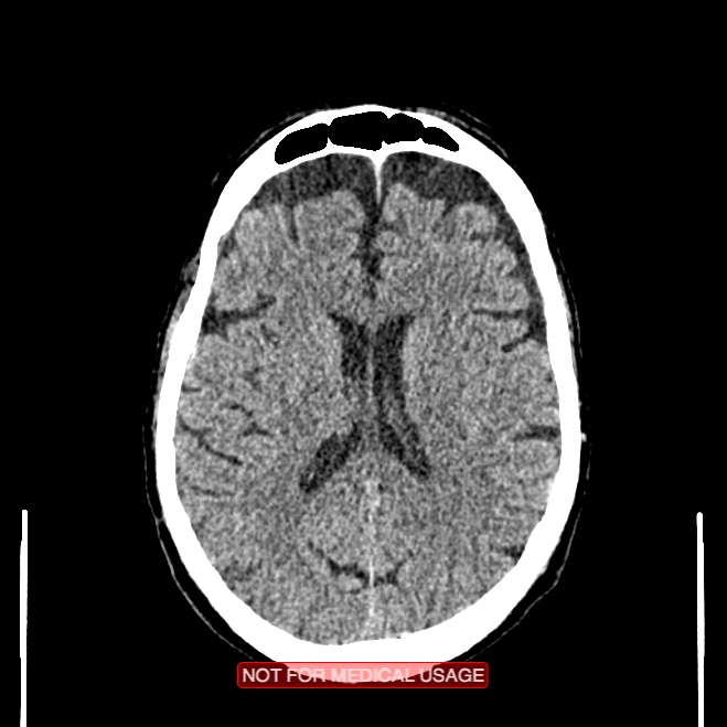 Artery of Percheron infarction (Radiopaedia 28679-28967 Axial non-contrast 71).jpg