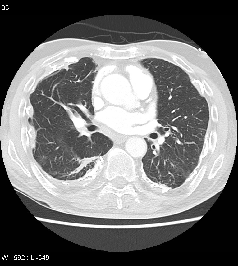 Asbestos related lung and pleural disease (Radiopaedia 14377-14301 A 30).jpg