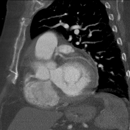 File:Ascending aortic aneurysm (Radiopaedia 20913-20846 A 9).jpg