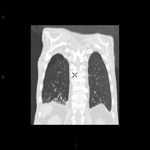 File:Aspergilloma (Radiopaedia 14842-14787 Coronal lung window 30).jpg