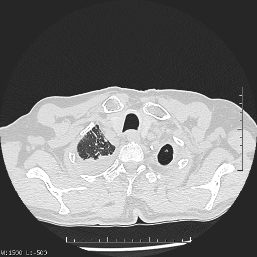 Aspergilloma (Radiopaedia 75184-86270 Axial lung window 5).jpg