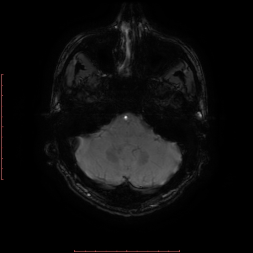 Astrocytoma NOS - cystic (Radiopaedia 59089-66384 Axial SWI 13).jpg