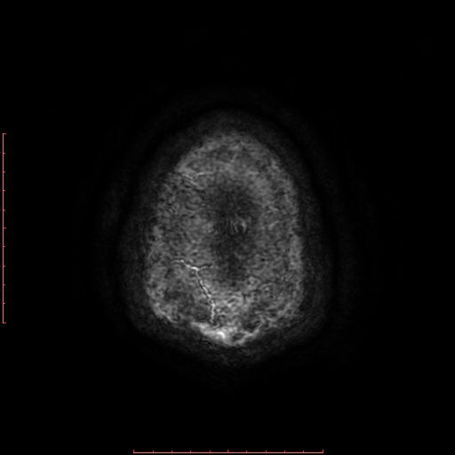 Astrocytoma NOS - cystic (Radiopaedia 59089-66384 Axial SWI 73).jpg