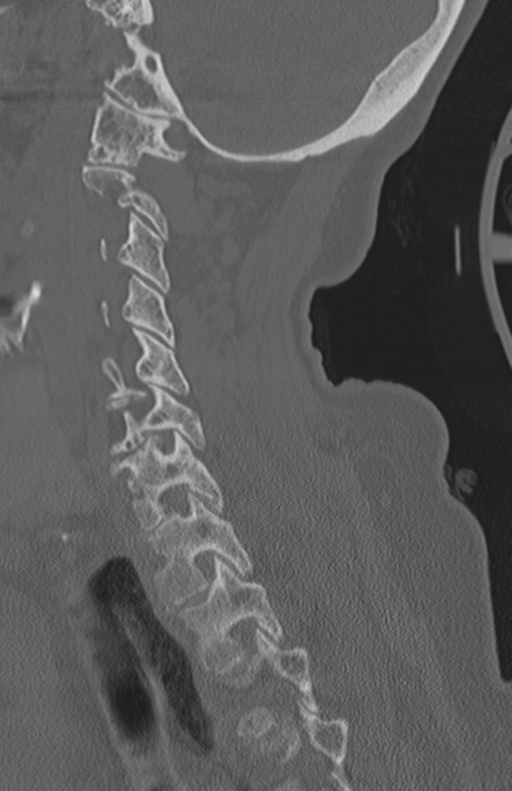 Atlanto-axial subluxation (Radiopaedia 36610-38176 Sagittal bone window 53).png