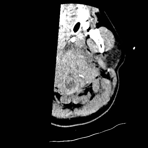 Atlanto-occipital dislocation (Radiopaedia 44648-48412 Axial non-contrast 1).jpg
