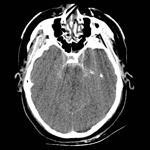Atlanto-occipital dislocation (Radiopaedia 44648-48412 Axial non-contrast 19).jpg